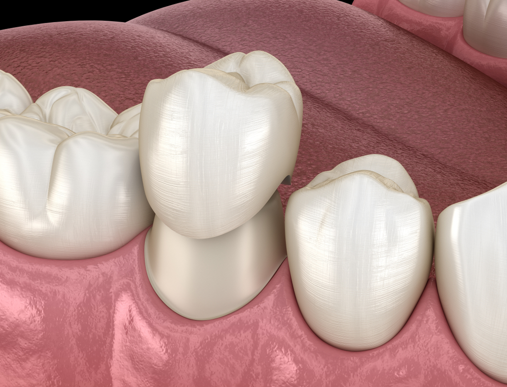 dental crowns