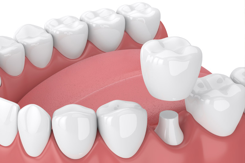 Dental Crowns in South Gate