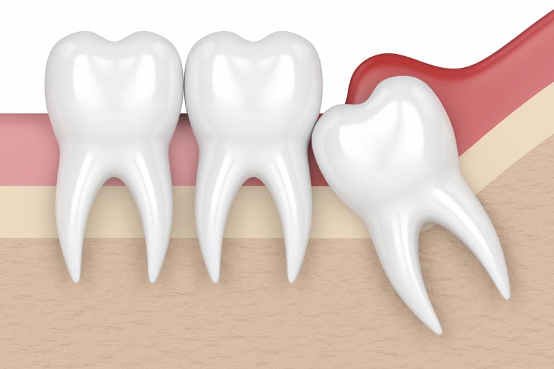 Wisdom Tooth Removal in South Gate